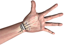 Wrist Joint Replacement