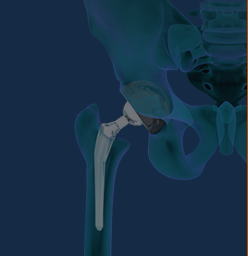 Total Joint Replacement