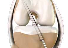 ACL Reconstruction