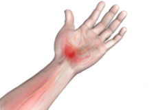 Carpal Tunnel Syndrome