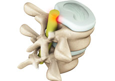 Cervical Spondylosis
