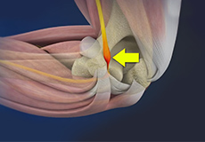 Ulnar Nerve Entrapment (Cubital Tunnel Syndrome) 