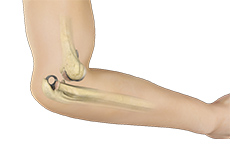 Elbow Dislocation