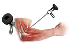 Elbow Arthroscopy