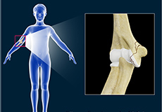  Elbow Fractures in Children