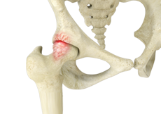 Femoroacetabular Impingement