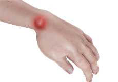 Ganglion Cyst