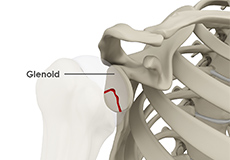 Glenoid Fractures