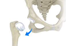 Hip Dislocation