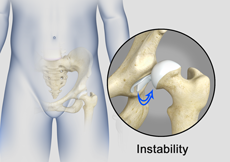 Hip Instability