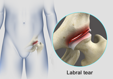 Hip Labral Tear