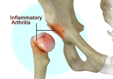 Inflammatory Arthritis of the Hip