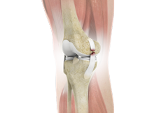 Arthroscopic Reconstruction of the Knee for Ligament Injuries