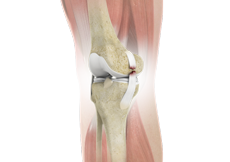 Ligament Injuries