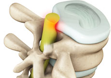 Lumbar Radiculopathy