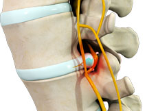 Lumbar Stenosis