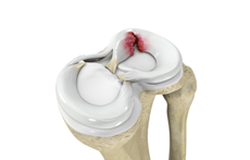 Meniscal Tears