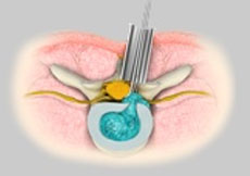 Minimally Invasive Spine Surgery