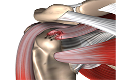 Arthroscopic Rotator Cuff Repair