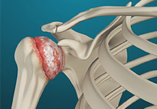 Arthritis of the Shoulder