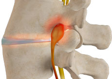 Spinal Stenosis

