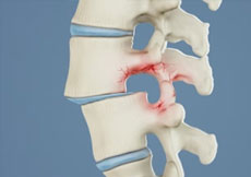 Spondylolisthesis