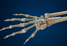 Total Wrist Arthrodesis