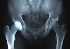 Transient Osteoporosis of the Hip